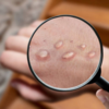 ​Internal lesions are the worst