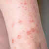 ​Small sores