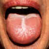 ​White patches in mouth