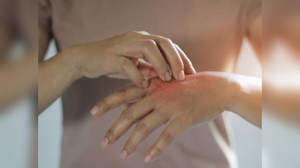 Skin rash is a potential sign of COVID