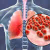 Legionnaires' disease