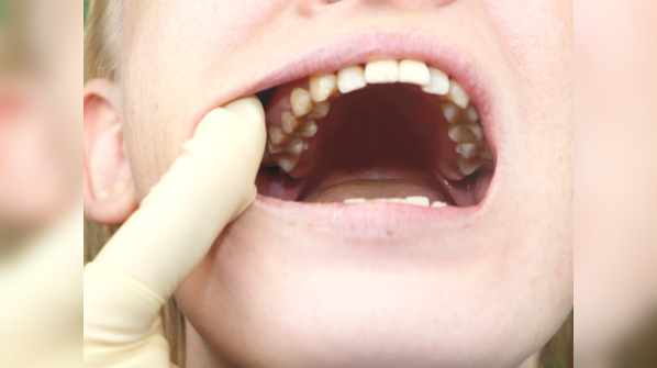 Global burden of oral cancer