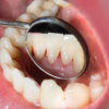 ​Oral diseases affect nearly 3.5 billion people