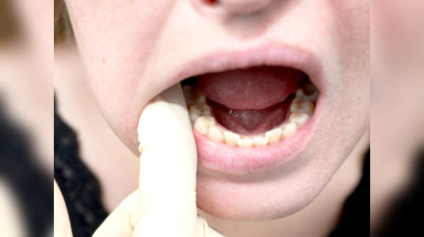 Loose teeth