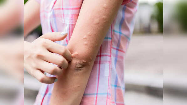 Hive-type rash