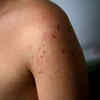 ​Chicken pox-type rash