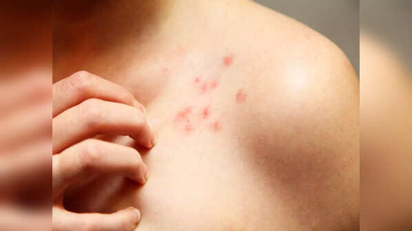 Lesser known COVID symptoms