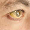 So, do not ignore the early symptoms of pancreatic cancer