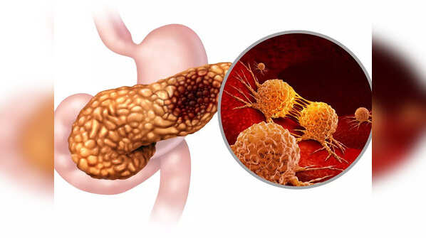 Types of pancreatic cancer