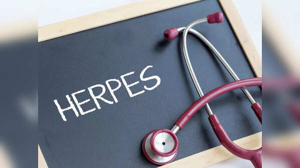 Genital Herpes