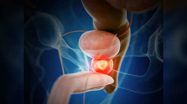 What is prostate cancer?
