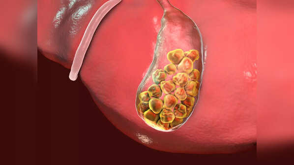 What are gallstones?