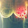 ​Diagnosis: Asymptomatic Breast Cancer