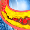 ​High cholesterol leads to vasculopathy​