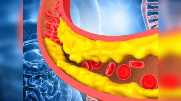 High cholesterol leads to vasculopathy
