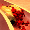 ​Is high cholesterol linked to long COVID?​