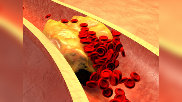 Is high cholesterol linked to long COVID?