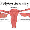 ​Polycystic ovarian syndrome
