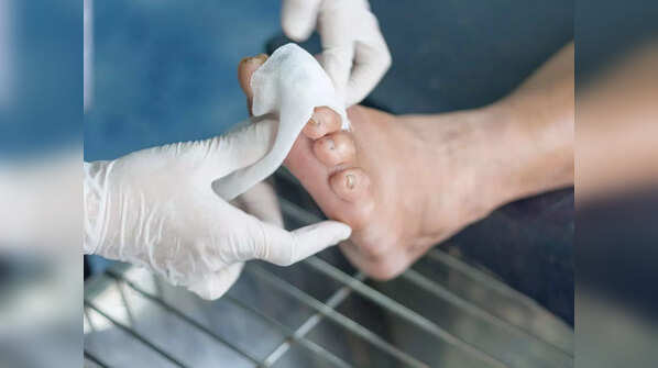 Diabetic foot ulcer warning sign