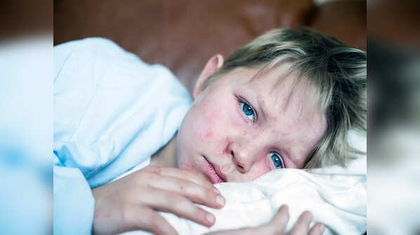 Symptoms of measles