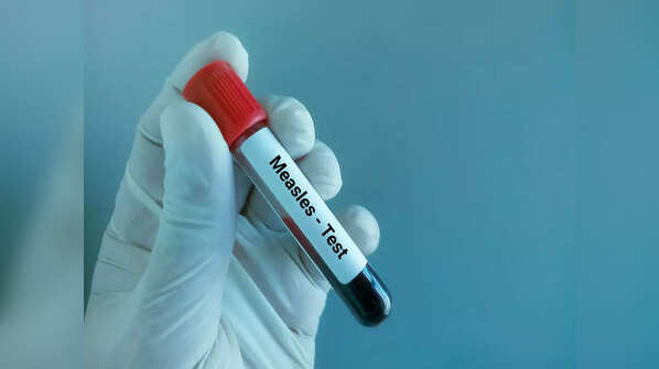Data of rise in measles cases