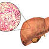 How does liver stiffness in COVID patients compare with those without a history of COVID?