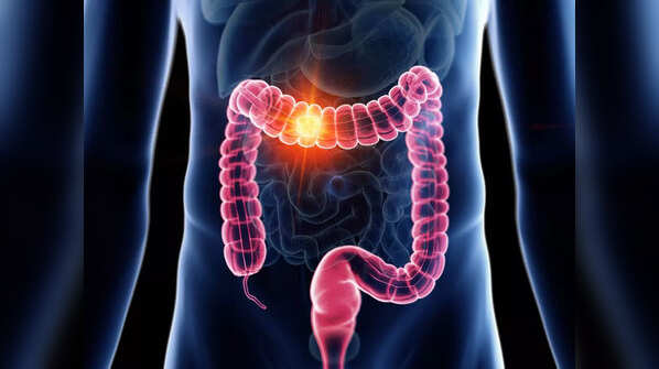 Where can bowel cancer spread to?