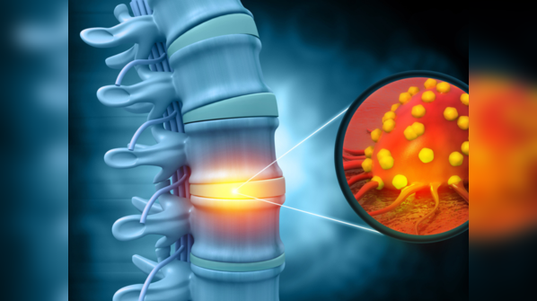 What are the symptoms associated with Chordoma?