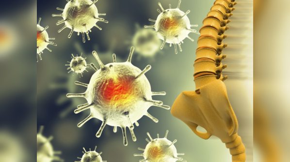 What is Chordoma?