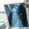 ​Diagnosis: Chordoma, a rare form of bone cancer
