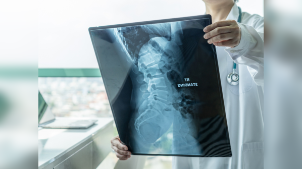 Diagnosis: Chordoma, a rare form of bone cancer