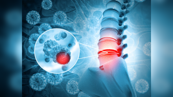 Psychology student shares how she survived Chordoma