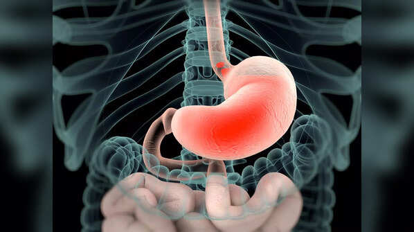 Acid reflux