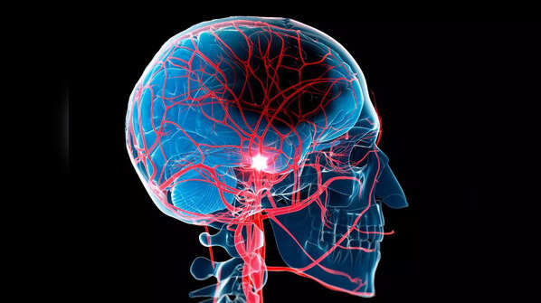 Stroke