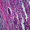 ​What causes Hodgkin's lymphoma