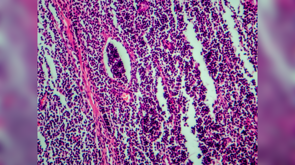 What causes Hodgkin's lymphoma