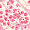 Other signs of breast cancer that can help you detect the disease
