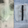 Finding magnetic beads that damaged his bowels