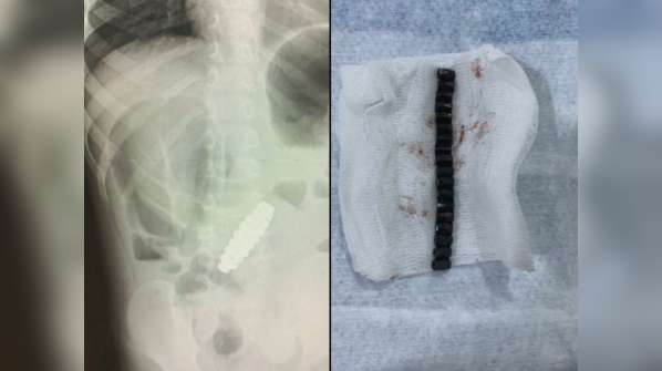 Finding magnetic beads that damaged his bowels