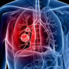 Pneumonia is a prominent cause of death