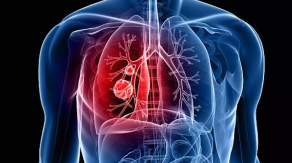 Pneumonia is a prominent cause of death