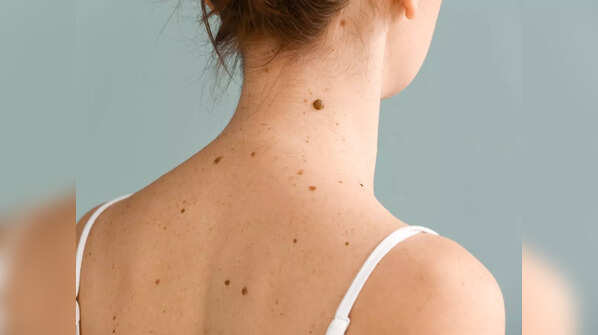 Changes in mole