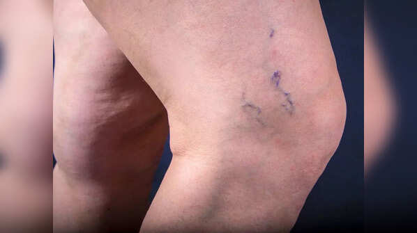 The primary cause of varicose veins