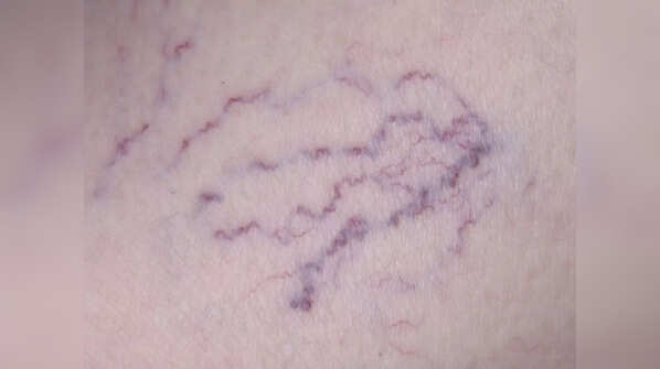 What are varicose veins?