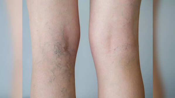 Venous disease and varicose veins