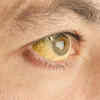 Yellowing of skin