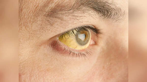 Yellowing of skin