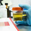 Dark urine