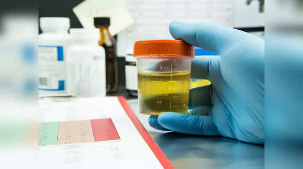 Dark urine