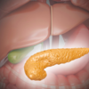 Signs and symptoms of chronic pancreatitis:
